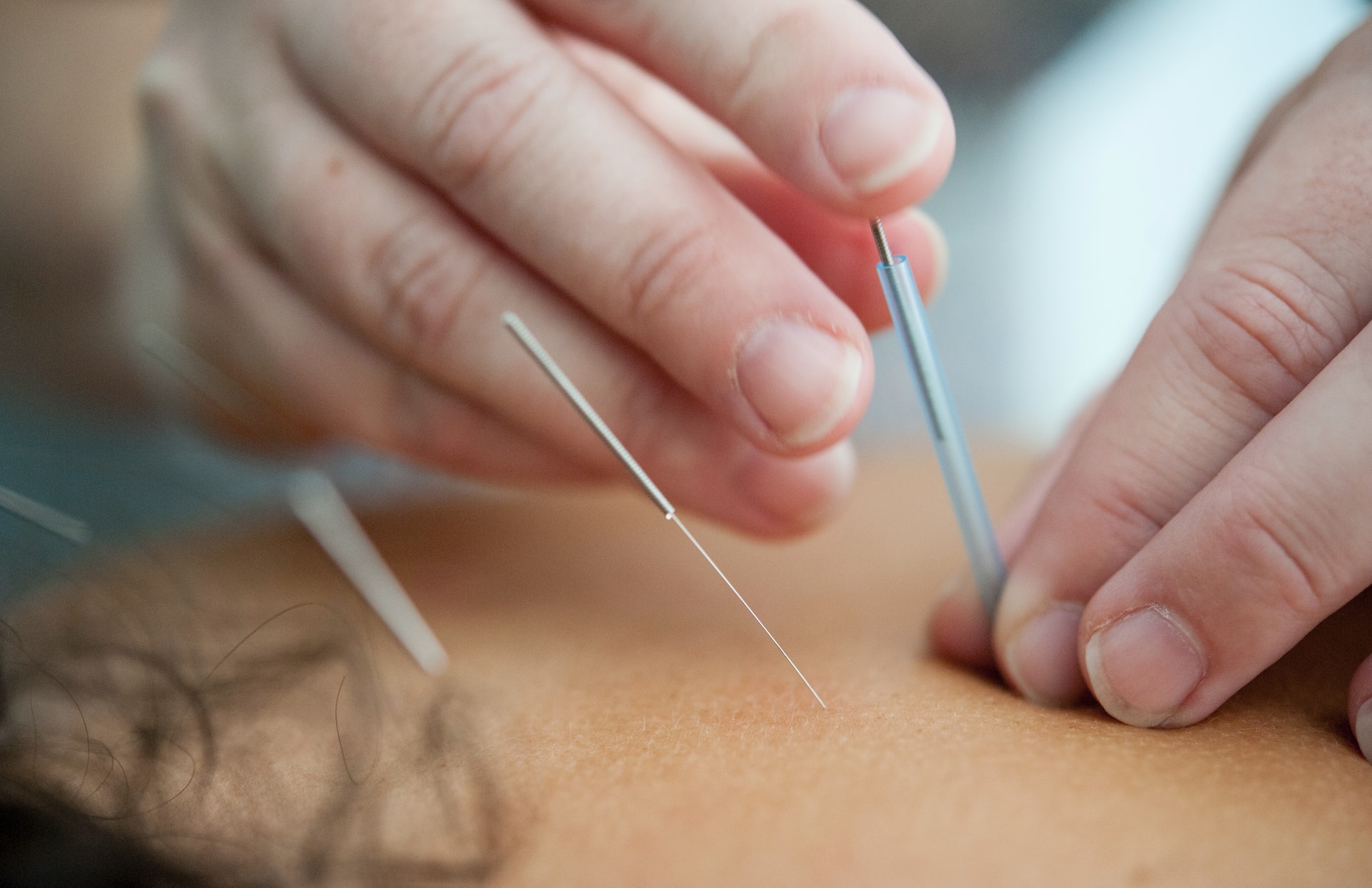 Mains qui placent des aiguilles d'acupuncture sur le dos d'une personne